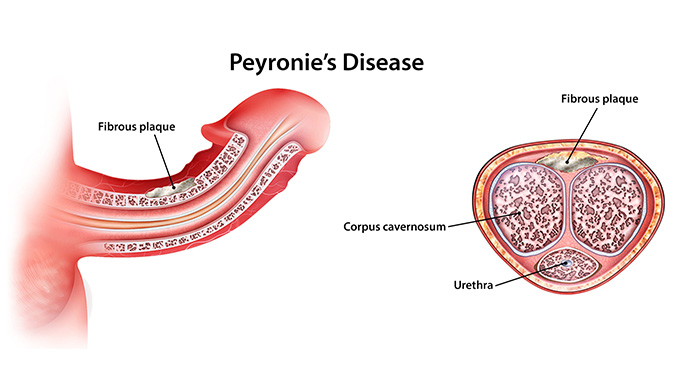 a diagram showing peyronie's disease, with labels highlighting the fibrous plaque that causes it