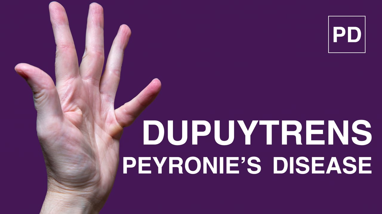 Dupuytrens Contracture and Peyronies Disease