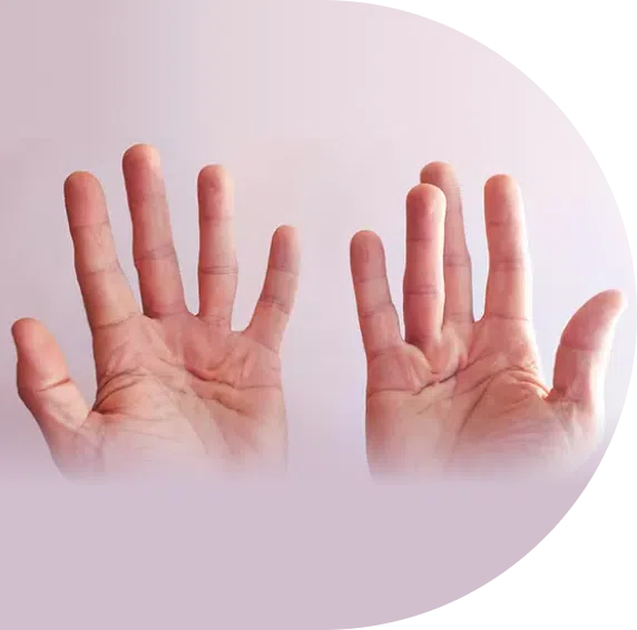 Peyronie's Disease & Genetics