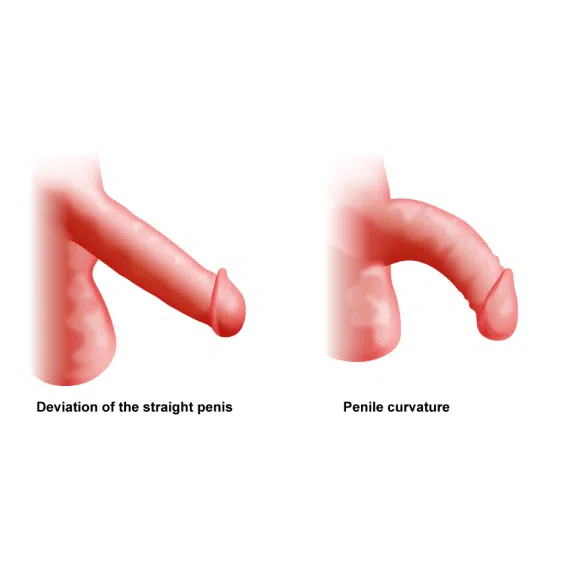 Congenital Peyronie’s Disease