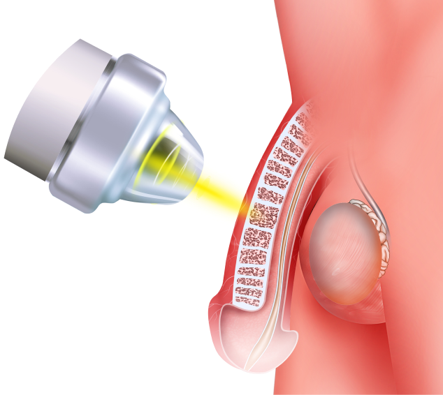 Patient Experiences in Peyronie's Disease Therapy