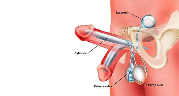 Peyronie's Disease & Implants 2
