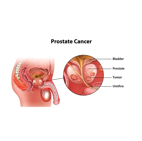 Peyronie’s Disease & Prostate Cancer