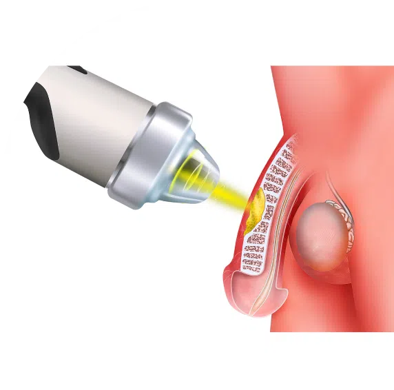 Peyronie’s Disease and Its Impact on Relationships