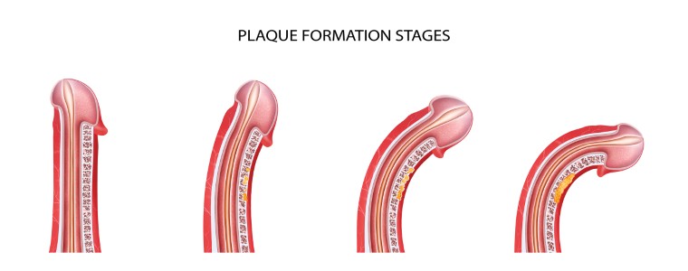 Plaque formation stages