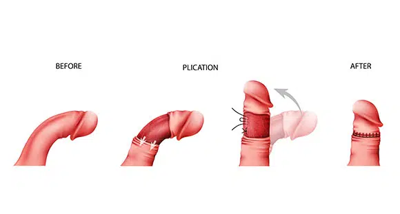 Plication surgical Procedure