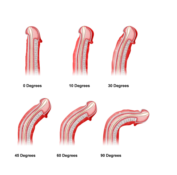 Peyronies Disease Peyronie s Disease Still A Surgical Disease