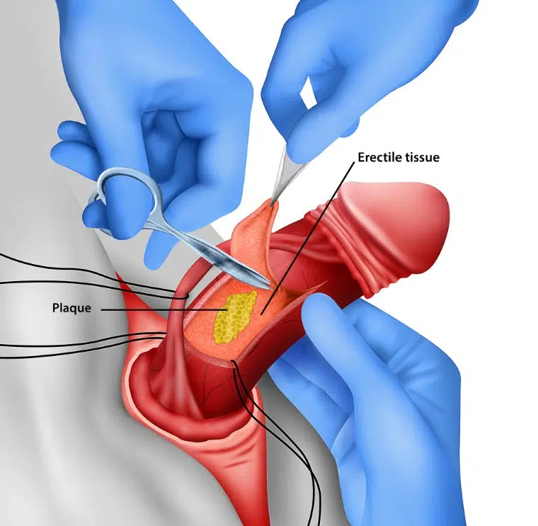 Surgical graft