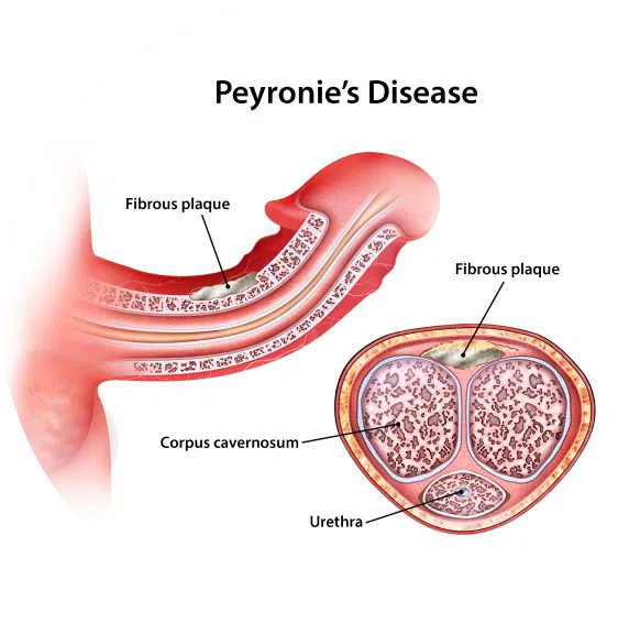 What is Peyronie's Disease