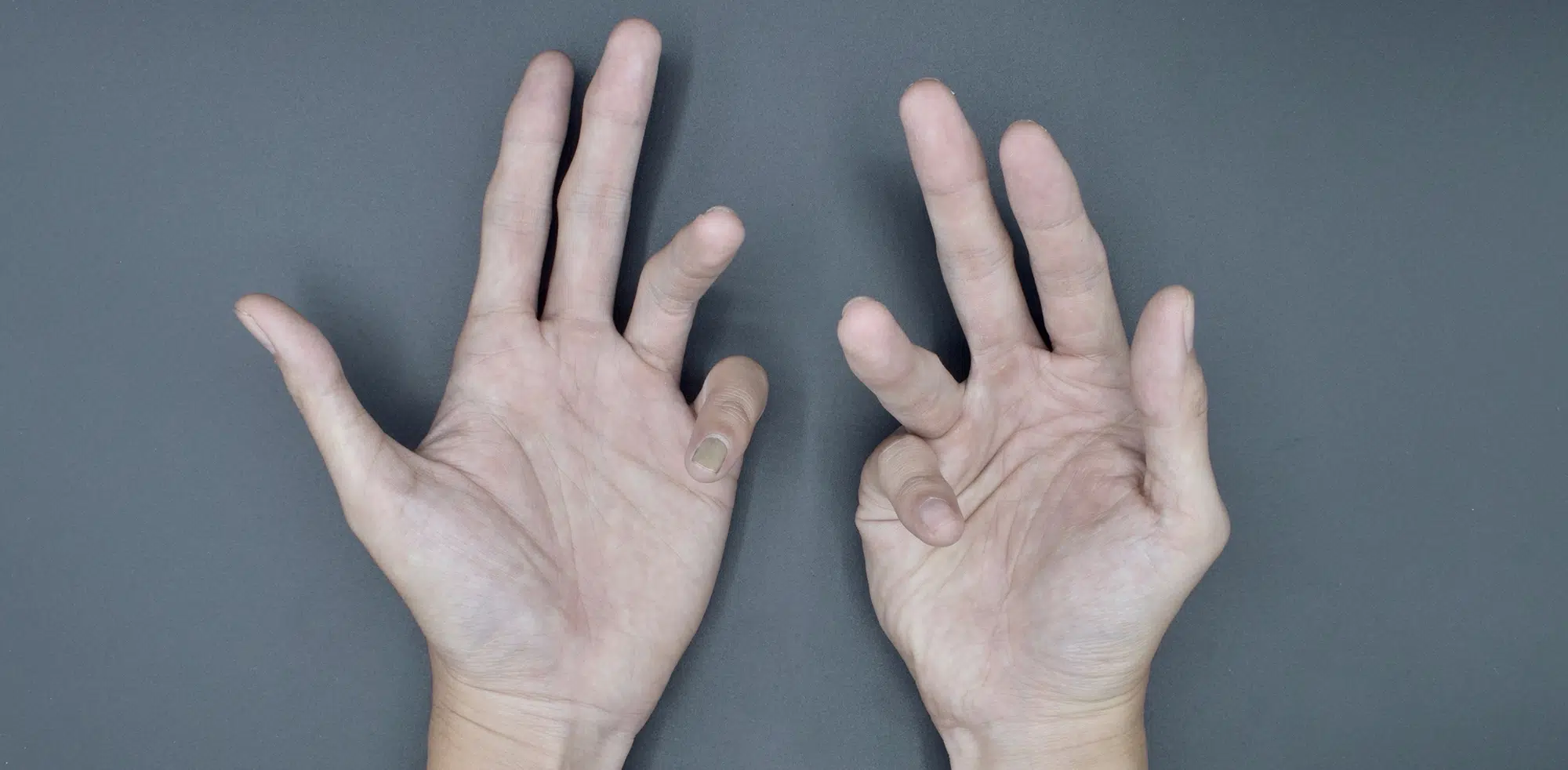 Peyronie’s Disease & Dupuytren’s Disease