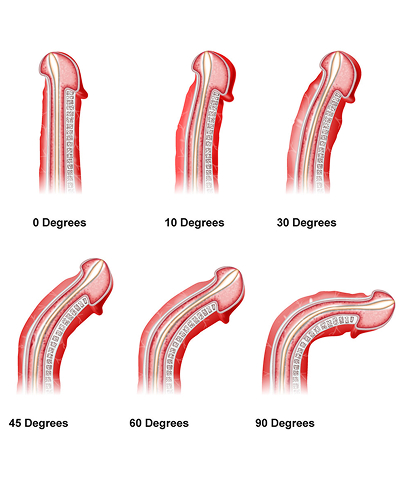 Illustration showing different degrees of penile curvature