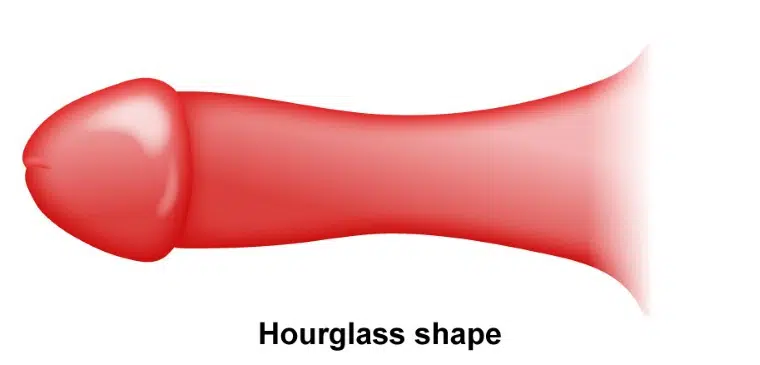 hourglass Peyronie’s disease treatment, penile narrowing, non-surgical Peyronie’s