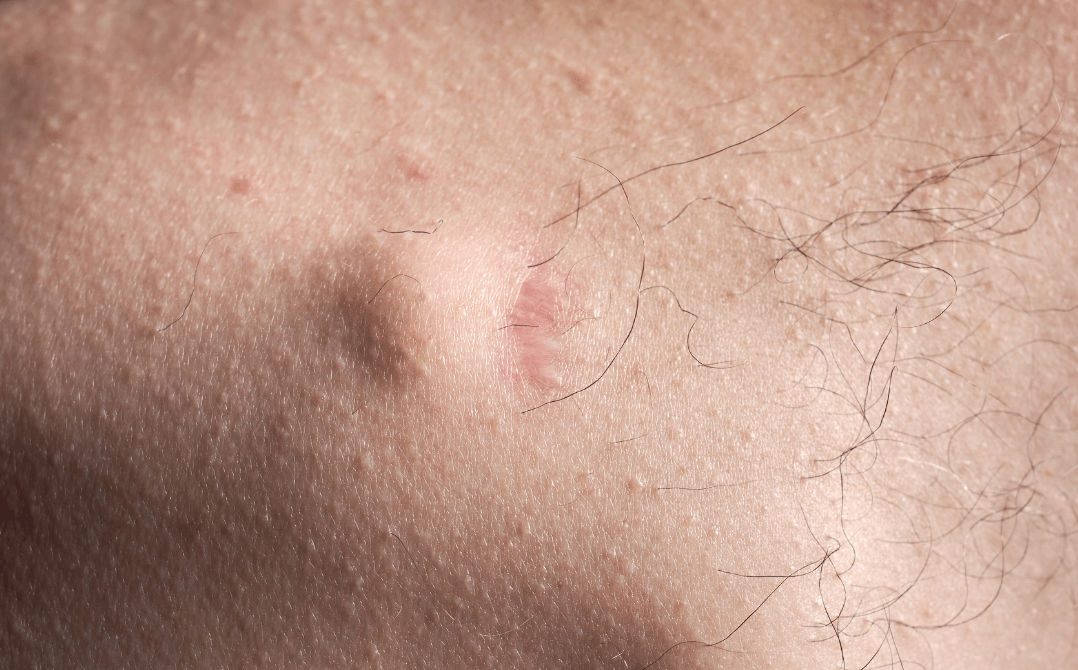 A Hard Lump or Plaque Under the Skin of the Penis