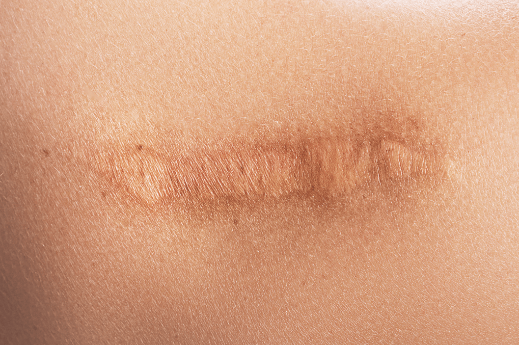 How Plaque Causes Curvature During Erections